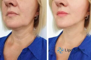 Double chin before and after Hi-Fu treatment 4 Book your double chin treatment Bishop's Stortford today! We are here to help!