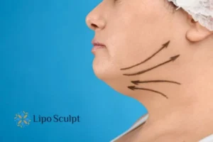 Double chin before and after Hi-Fu treatment 3 Boost your confidence with a Double chin treatment Bishop's Stortford