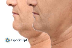 Double chin before and after Hi-Fu treatment 2 Double chin treatment Bishop's Stortford from Lipo Sculpt - feel more confident today!