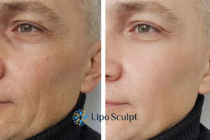 How to Fight Aging Symptoms 3 Fight Aging Symptoms Bishop's Stortford With HIFU and Morpheus8 Today!