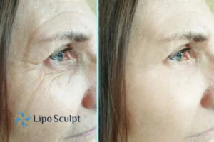 How to Fight Aging Symptoms 2 Do you want to Fight Aging Symptoms Bishop's Stortford? Contact Lipo Sculpt today!
