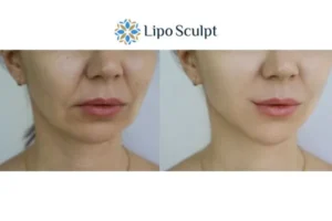 Explaining Total Skin Tightening Treatment And What It Can Do For You 2 Do you want to boost your self confidence? Give Morpheus8 Bishop's Stortford a try today!