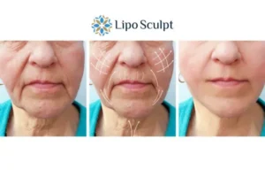 Explaining Total Skin Tightening Treatment And What It Can Do For You 3 Boost your confidence with Morpheus8 Bishop's Stortford call our team today!
