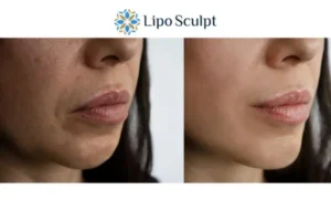 Explaining Total Skin Tightening Treatment And What It Can Do For You 4 Morpheus8 Bishop's Stortford the best results - call our team today!