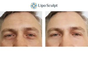 Explaining Total Skin Tightening Treatment And What It Can Do For You 6 Morpheus8 Bishop's Stortford book in today to find out more!