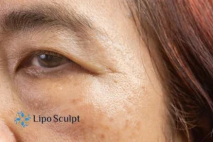 Cryopen: The Revolutionary Treatment for Age Spots Unveiled 2 Are age spots Bishop's Stortford giving you low self esteem? Contact us today!