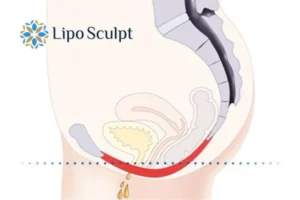 Pelvic Floor Chair Therapy 1 Pelvic Floor Chair Therapy Bishop's Stortford to treat incontinence.
