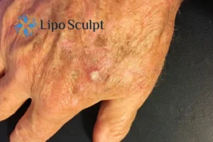 Best Actinic Keratoses Removal 2 Improve your wellbeing and health with Actinic Keratoses Bishop's Stortford removal.treatment