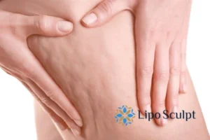 CoolSculpting for Legs: The Innovative Approach to Redefining Your Legs 5 Start your journey today book your coolsculpting treatment Bishop's Stortford online today!