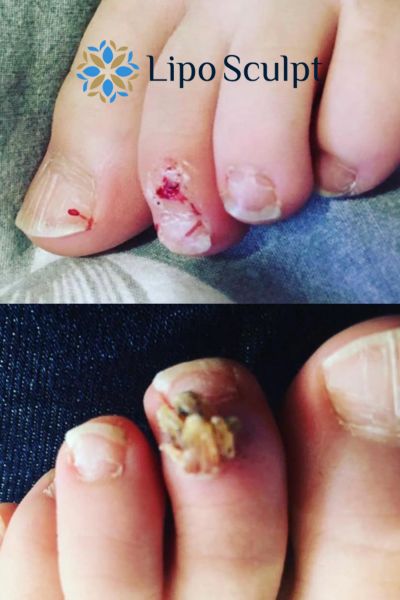 Wart removal customer results from Lipo Sculpt Bishop's Stortford