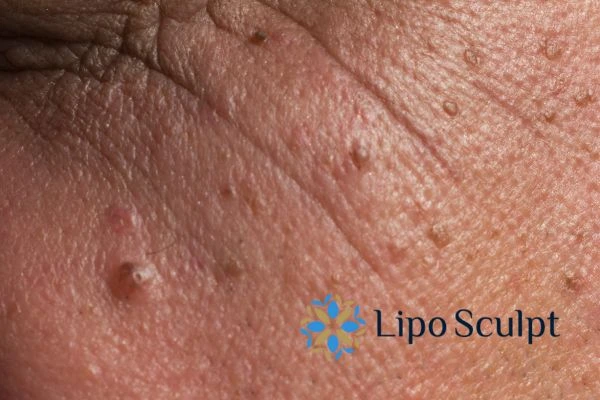 How to Improve the Appearance of Ageing Skin: HIFU and RF Microneedling Explained 4 Frequently Asked Questions