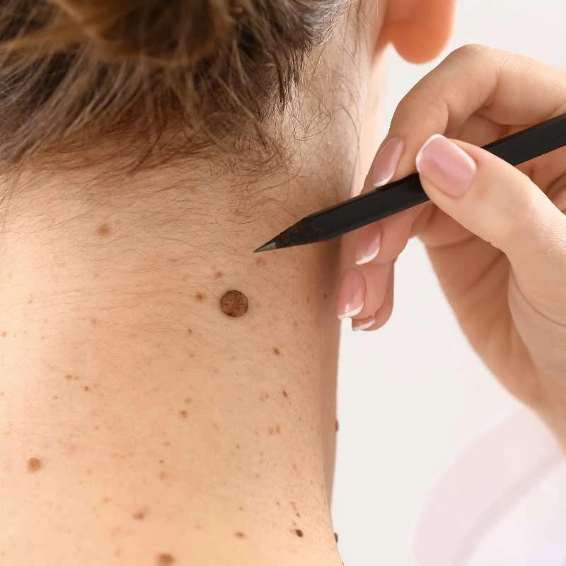 How to Support Your Body During Pregnancy for Faster Postnatal Recovery 5 See our lesion removal prices Bishop's Stortford - call today for a free quote