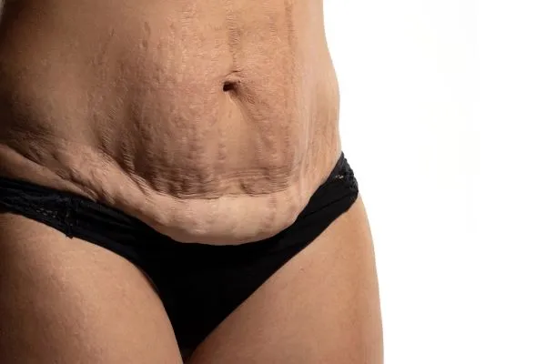 Lost the Weight but Not the Loose Skin? 1 image of womans stomach after weight loss showing loose skin Bishop's Stortford