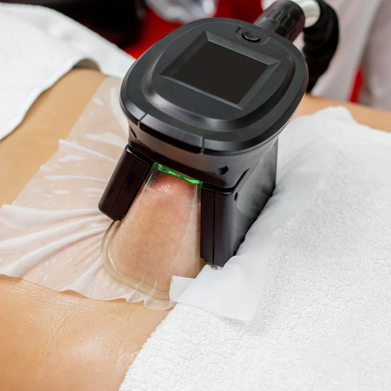 Fat Freezing treatment Bishop's Stortford